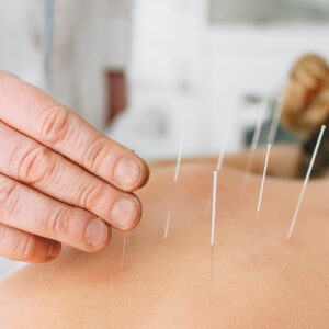 what is acupuncture