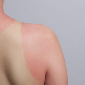 Treat sunburn naturally