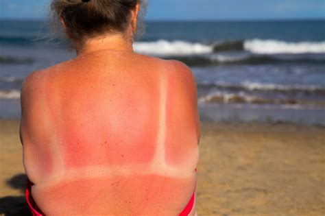 treat sunburn naturally